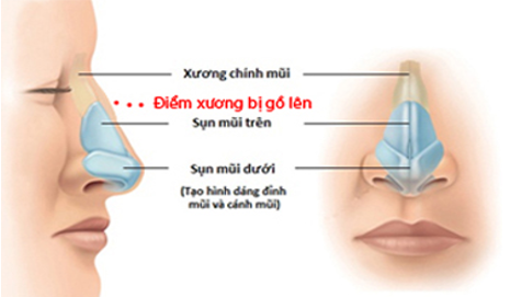 sua mui go thanh sua mui dep tu nhien